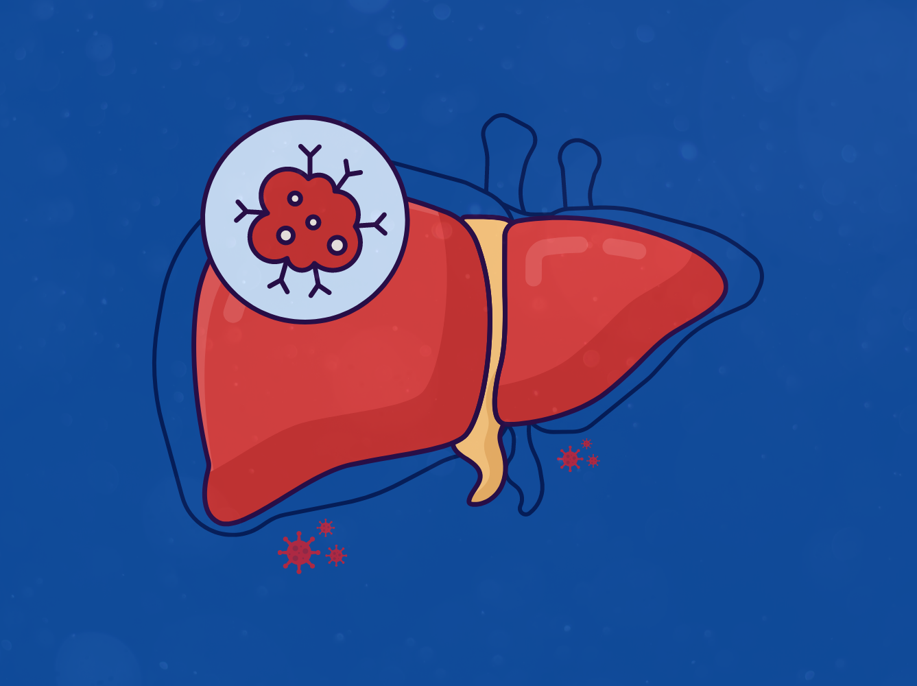 التهاب الكبد الفيروسي